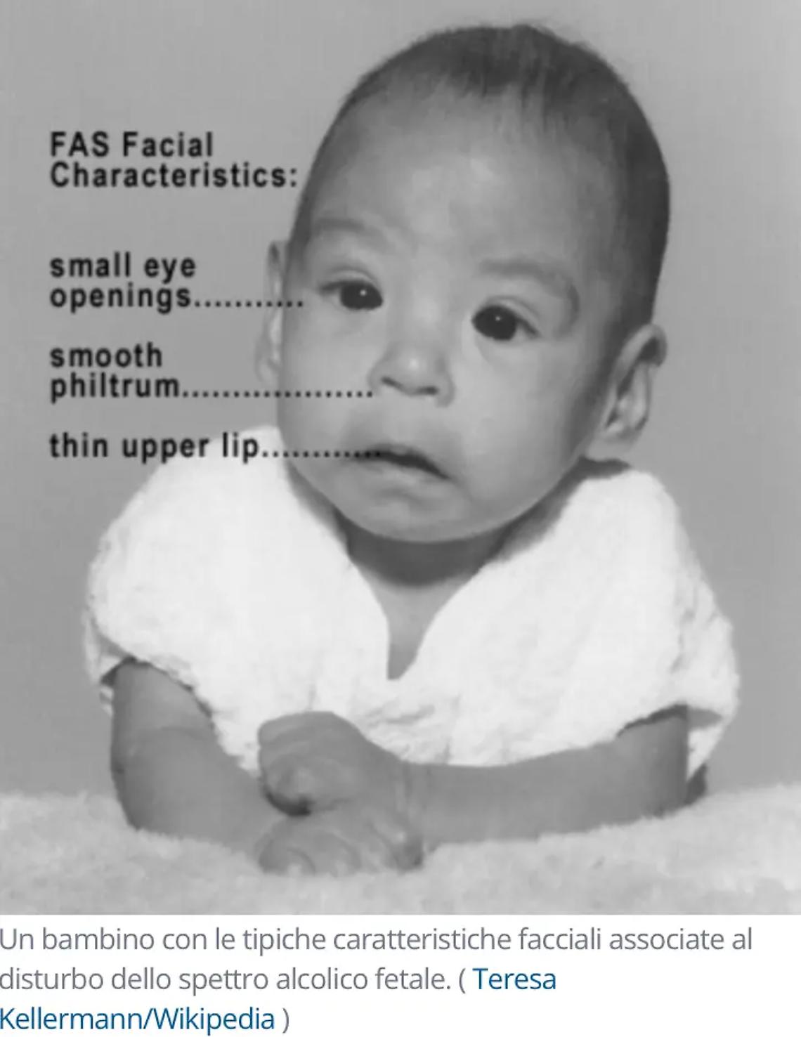Alcol in gravidanza, rischio cambiamenti sul volto del bambino