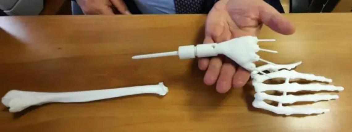 Un polso realizzato con una stampante 3D salva la mano di una neo-mamma