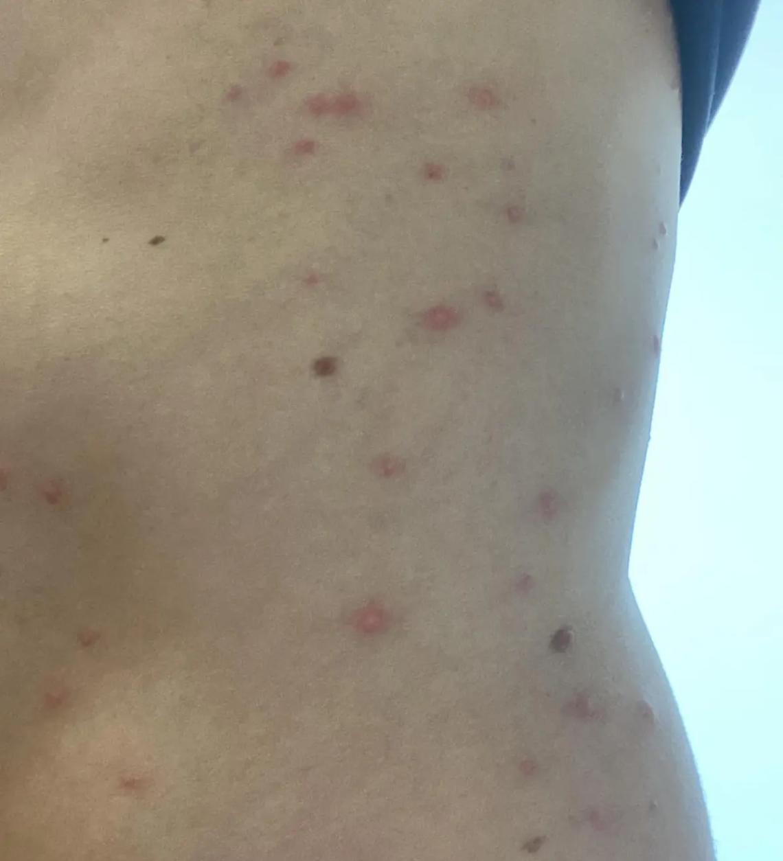 Dopo i serpenti tornano anche le &ldquo;pulci di mare&rdquo;