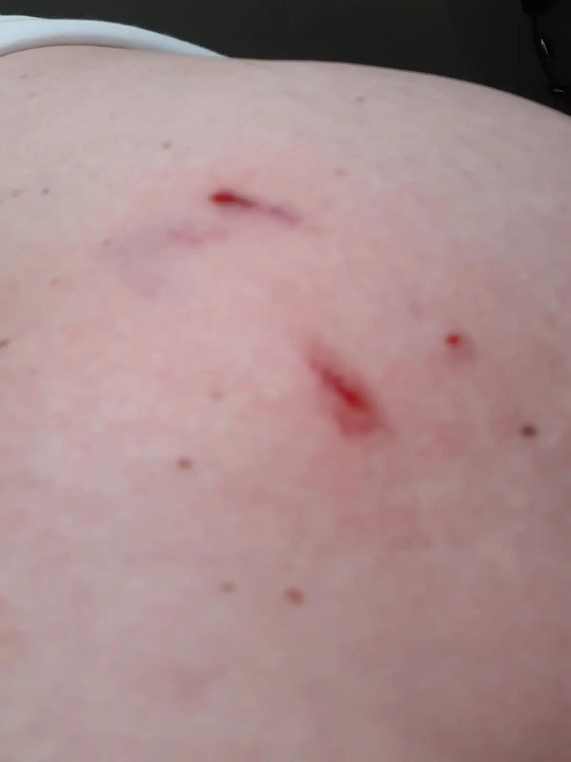 Assalita e morsa da un cane per difendere il suo cucciolo