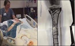 Milano Cortina, Vonn mostra la gamba dopo le operazioni: "Dolore difficile da gestire"