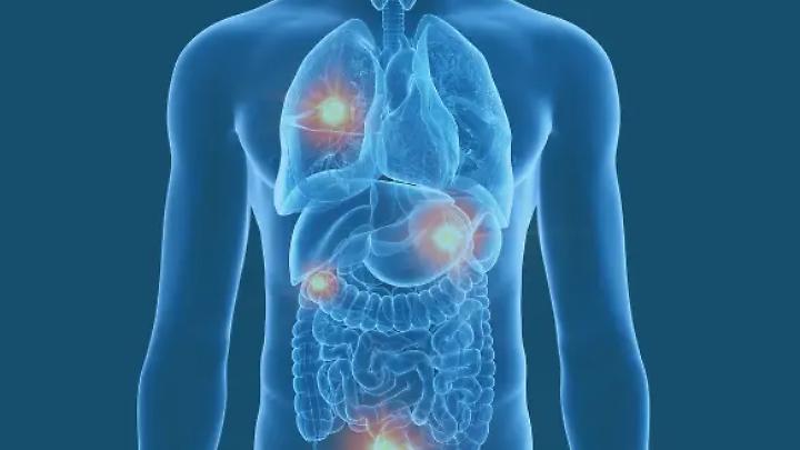 Cancro metastatico, la scienza avanza e iniziano grandi speranze