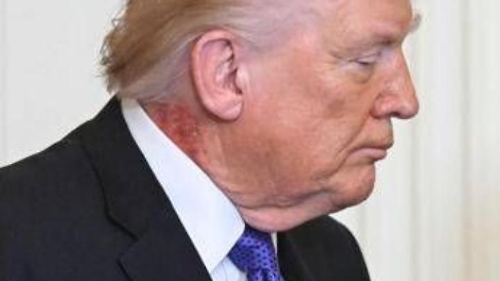 Trump e il collo arrossato, la foto riaccende i dubbi sulla salute del presidente